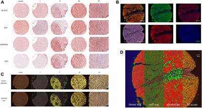 LV5plex: Immune-histological phenotypes staged by self-studying for a liver cancer multiplex staining set